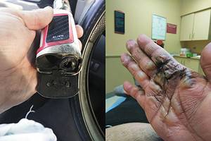 Damage caused by vape device explosion